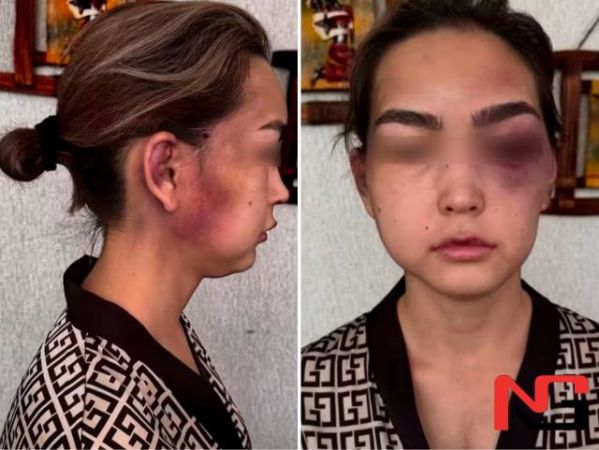 Сурхондарёда аёл эри томонидан аёвсиз калтакланди