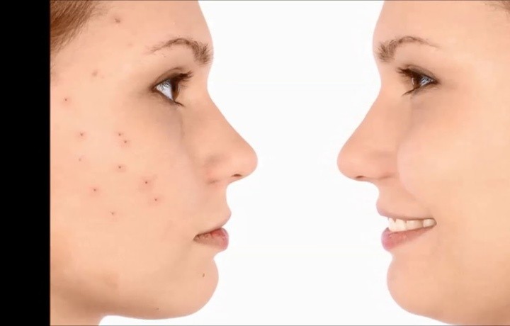 Юздаги ҳуснбузар қайси касалликлар аломати?