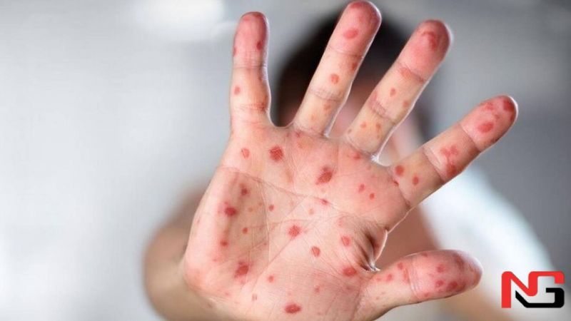 Ўзбекистонда маймунчечак вирусига қарши қандай чоралар кўрилмоқда?