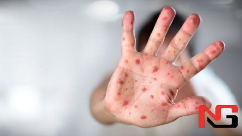 Ўзбекистонда юздан ошиқ қизамиққа чалинганлар аниқланди. Расмий маълумот