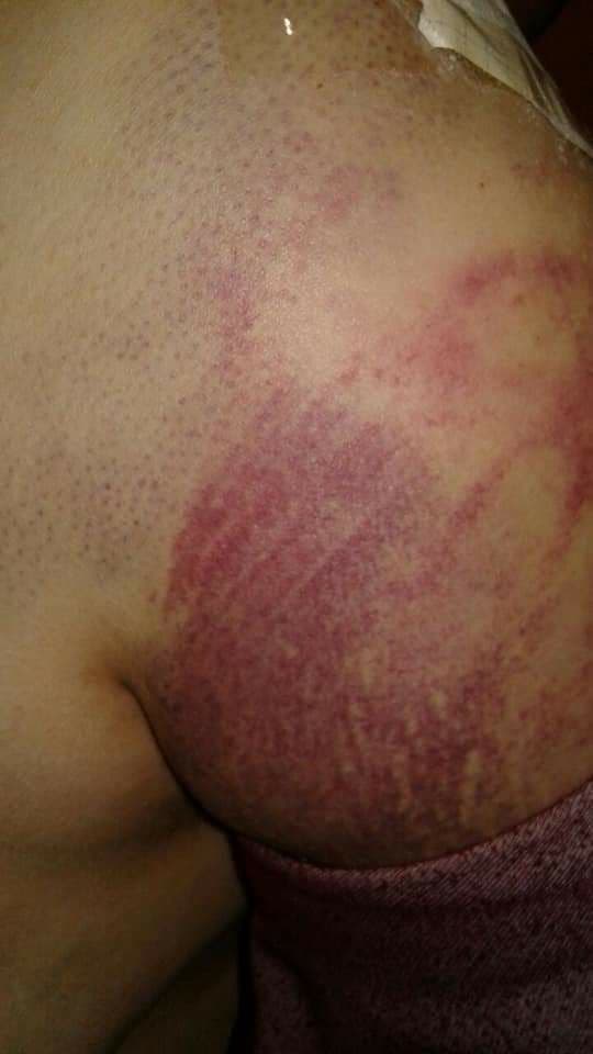 Тўрақўрғонда 9 ойлик келин эри томонидан аёвсиз калтаклаб келингани маълум бўлди