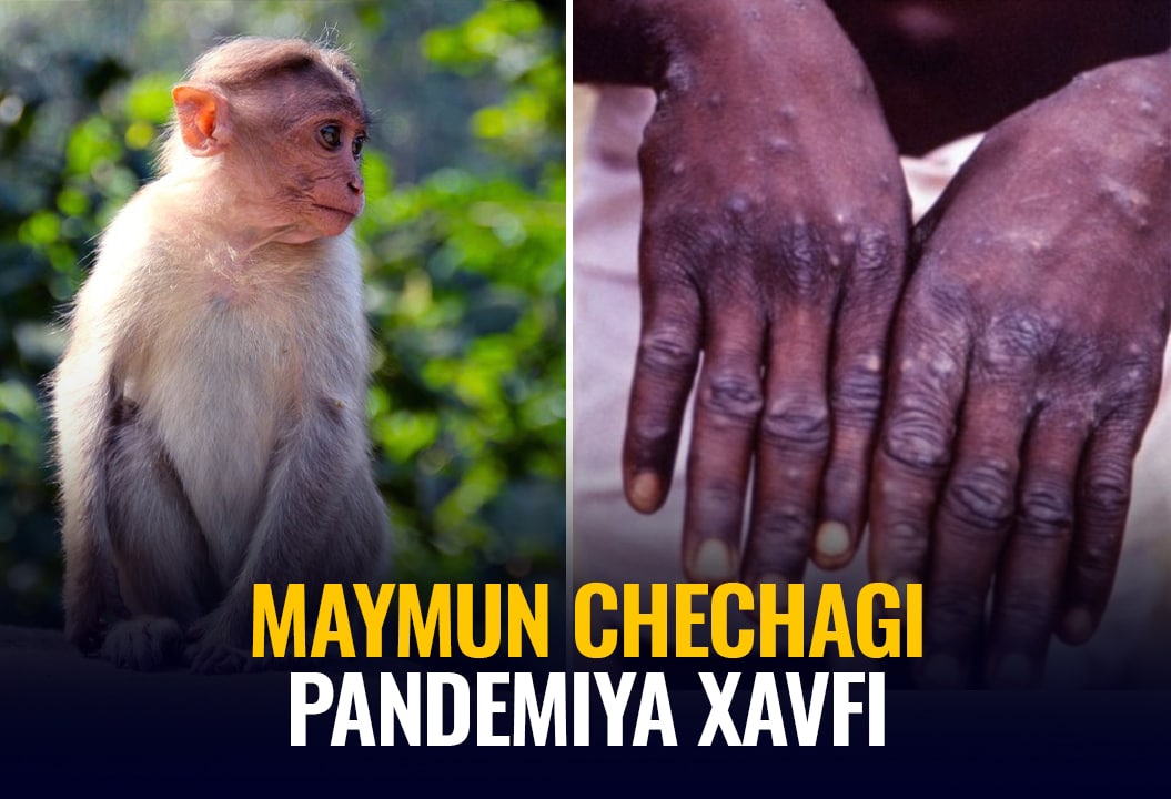 Маймун чечаги: Тез юқмайдиган ва ўлим кўрсаткичи паст касаллик нега дунёни хавотирга солмоқда?