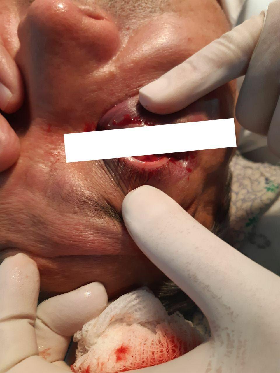 Наманганда шифокорнинг кўзини кўр қилган муштумзўр ушланди