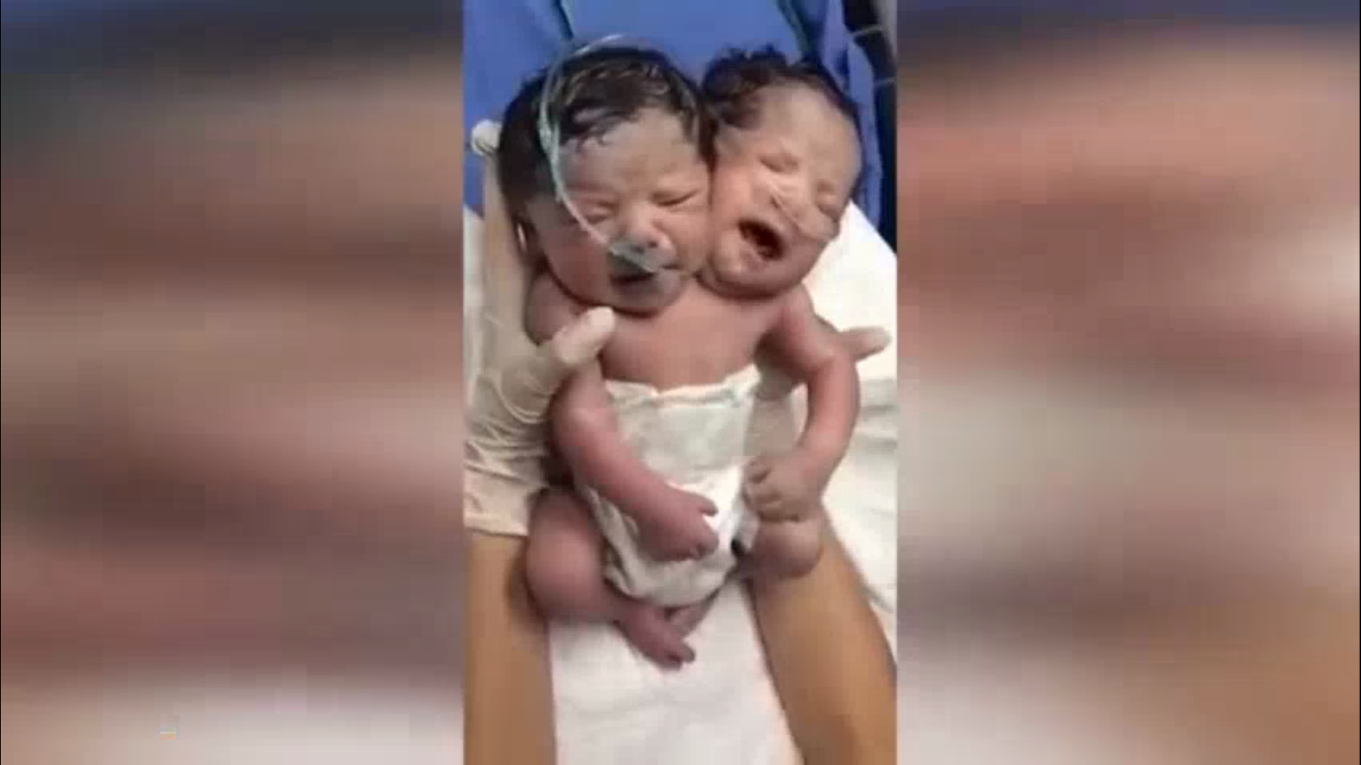 Ўзбекистонда сиам эгизаклари туғилгани ростми? Вазирлик изоҳ берди